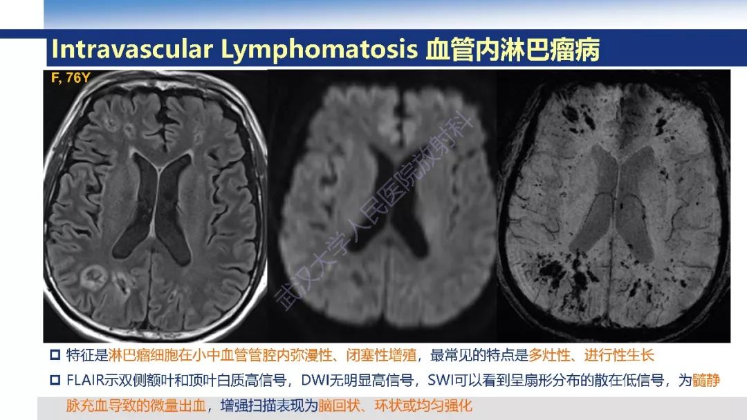 【PPT】大脑髓静脉解剖及疾病影像诊断