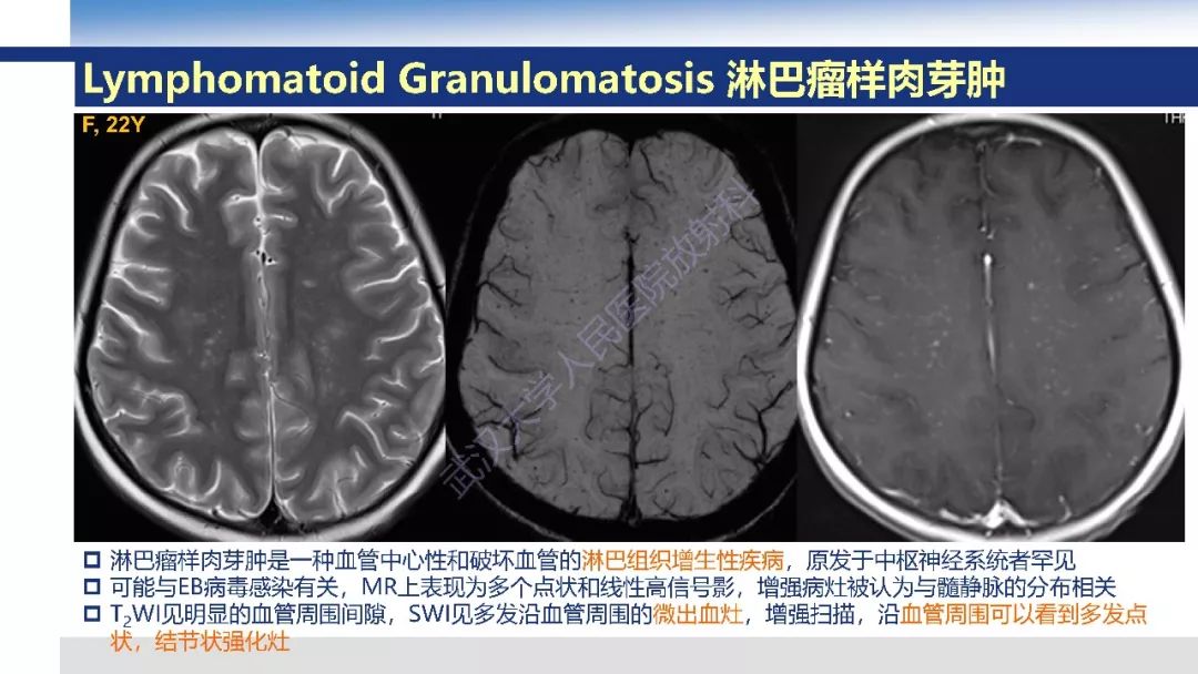 【PPT】大脑髓静脉解剖及疾病影像诊断