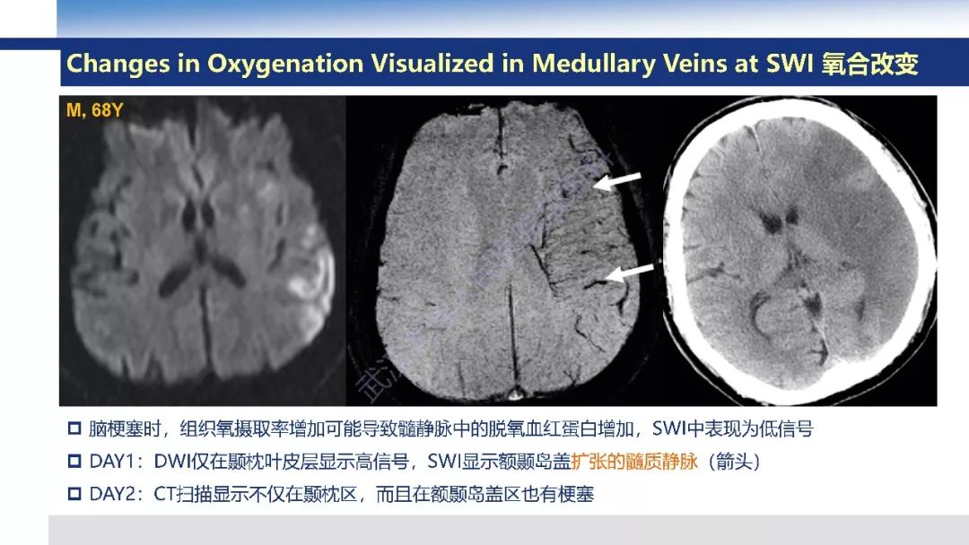 【PPT】大脑髓静脉解剖及疾病影像诊断