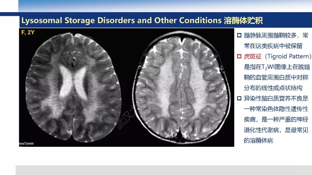 【PPT】大脑髓静脉解剖及疾病影像诊断