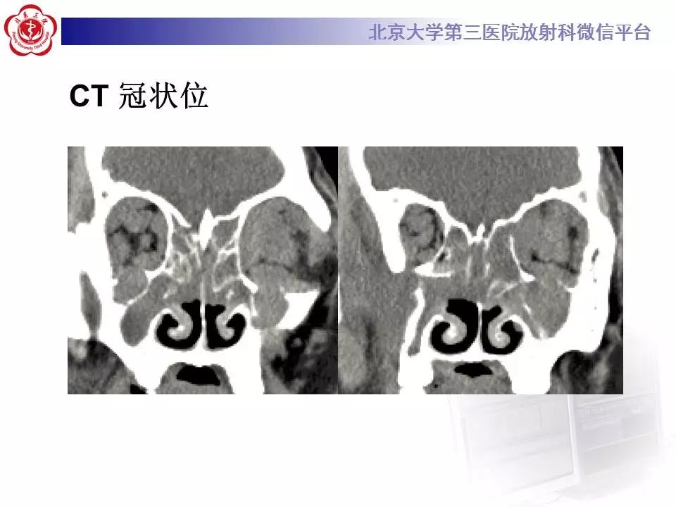 【病例】眼眶炎性假瘤1例CT影像诊断