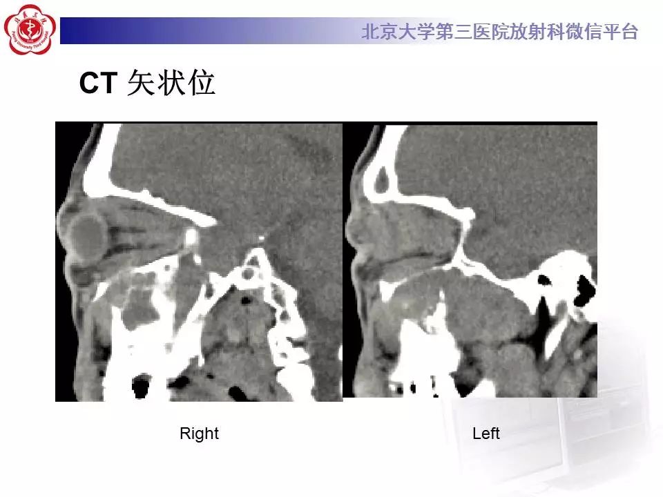 【病例】眼眶炎性假瘤1例CT影像诊断