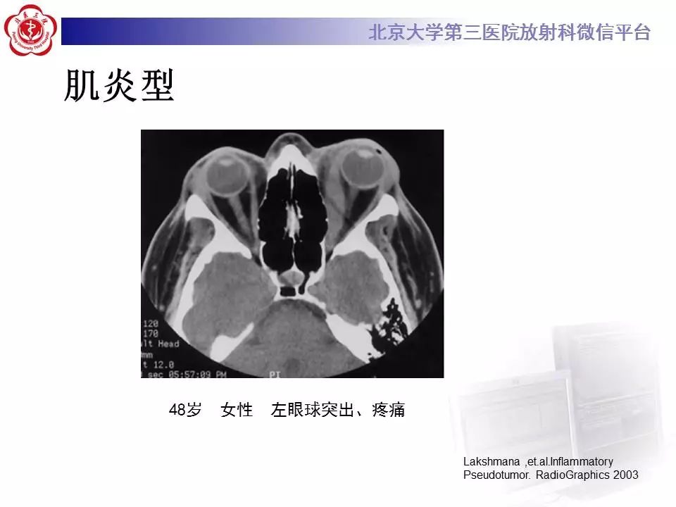 【病例】眼眶炎性假瘤1例CT影像诊断