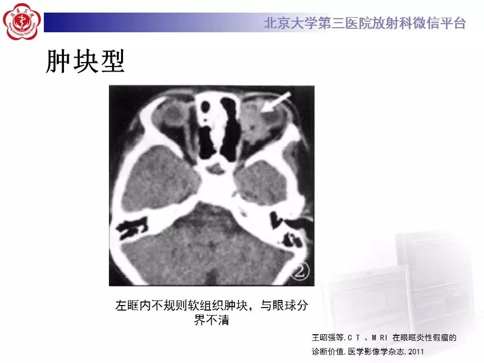 【病例】眼眶炎性假瘤1例CT影像诊断