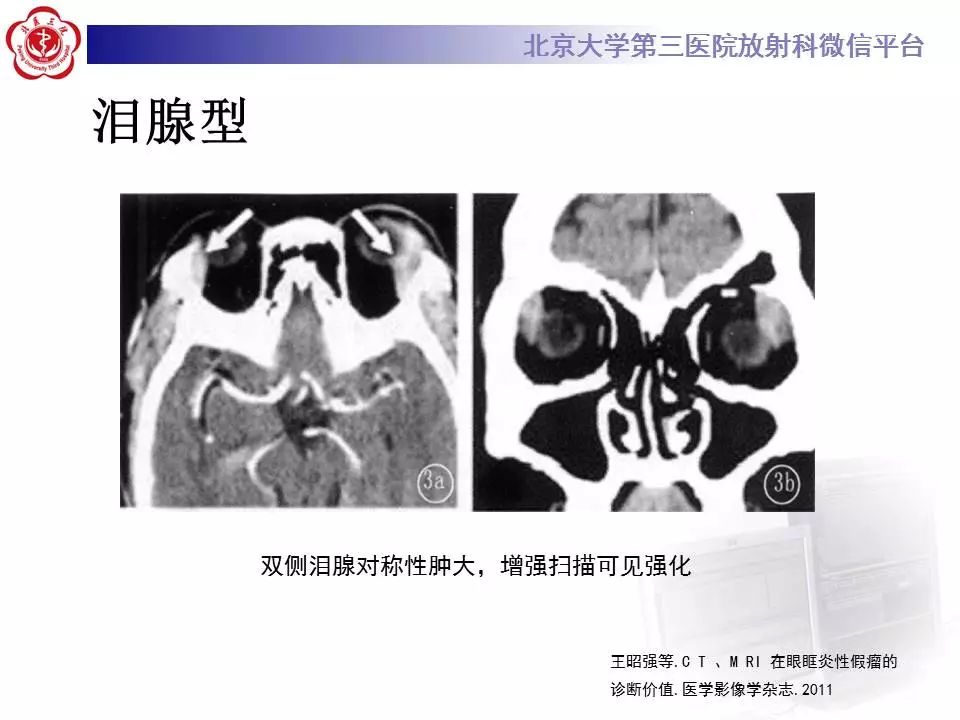 【病例】眼眶炎性假瘤1例CT影像诊断