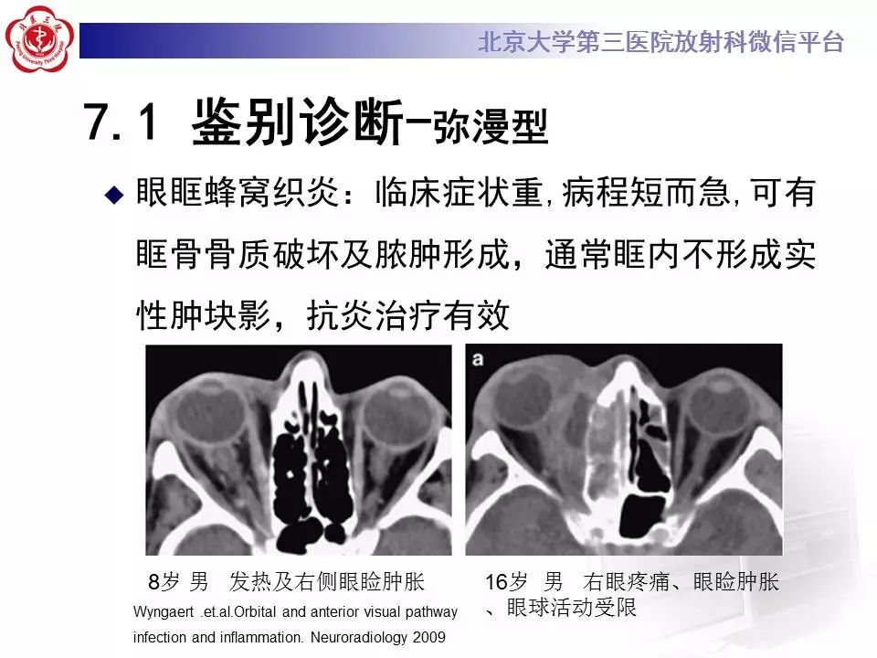 【病例】眼眶炎性假瘤1例CT影像诊断
