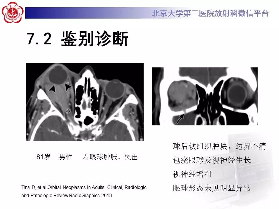 【病例】眼眶炎性假瘤1例CT影像诊断
