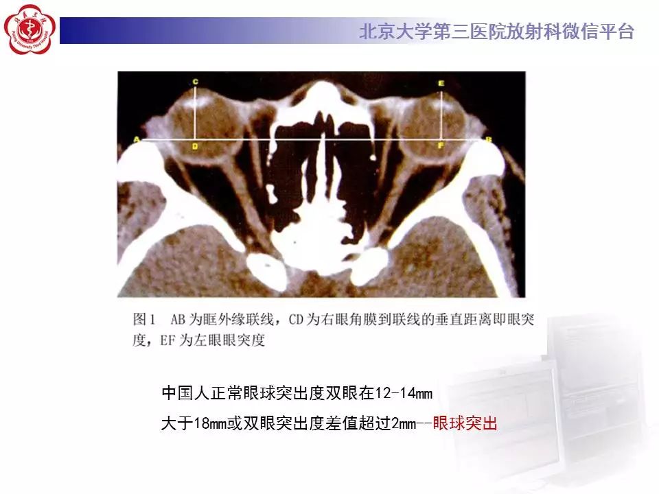 【病例】眼眶炎性假瘤1例CT影像诊断