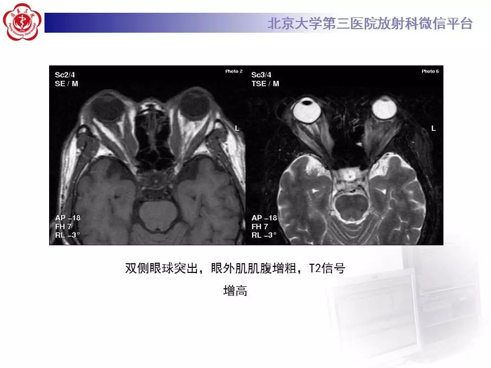【病例】眼眶炎性假瘤1例CT影像诊断
