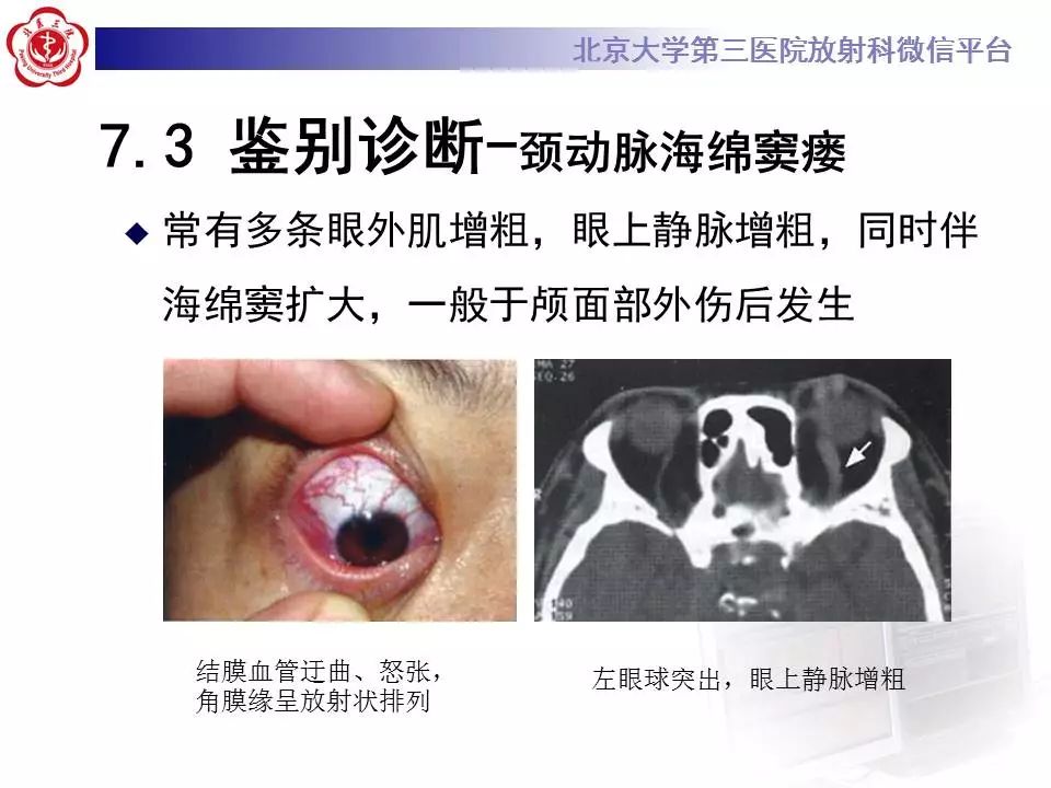 【病例】眼眶炎性假瘤1例CT影像诊断