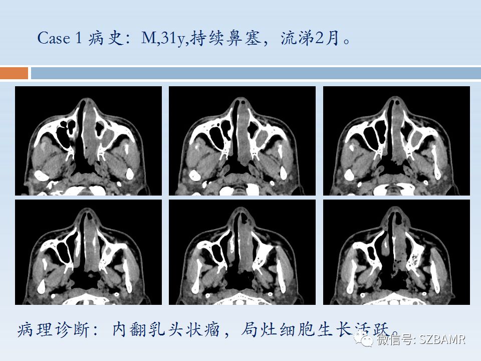 【PPT】鼻腔内翻性乳头状瘤影像学诊断