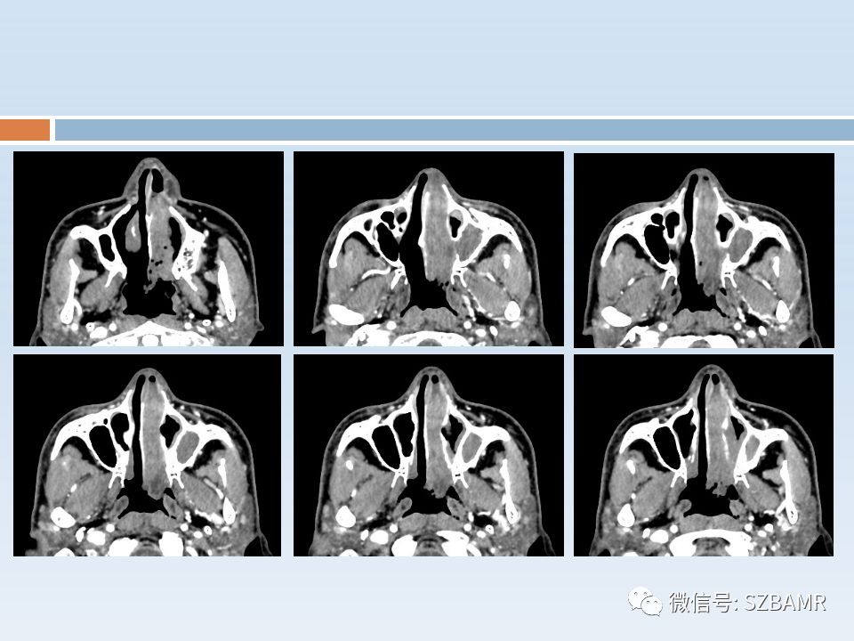 【PPT】鼻腔内翻性乳头状瘤影像学诊断
