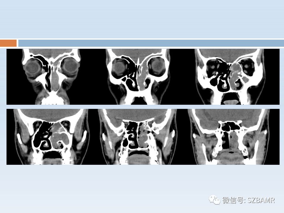 【PPT】鼻腔内翻性乳头状瘤影像学诊断