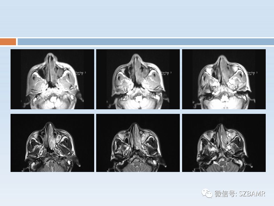 【PPT】鼻腔内翻性乳头状瘤影像学诊断