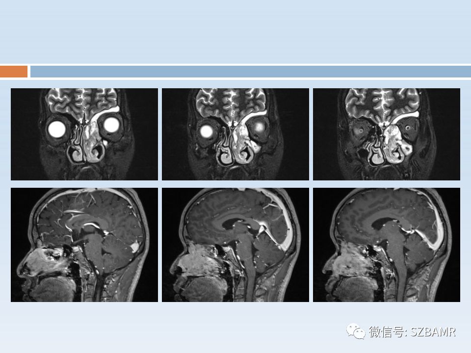 【PPT】鼻腔内翻性乳头状瘤影像学诊断