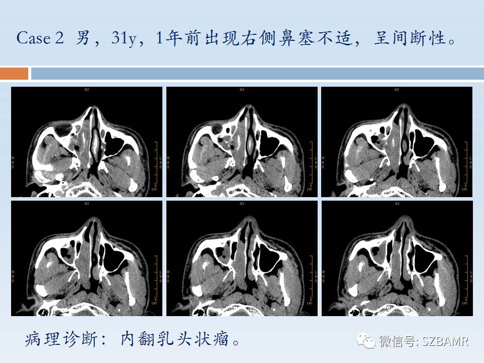 【PPT】鼻腔内翻性乳头状瘤影像学诊断