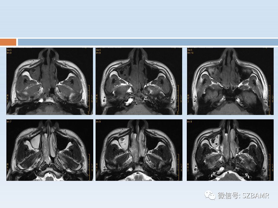 【PPT】鼻腔内翻性乳头状瘤影像学诊断