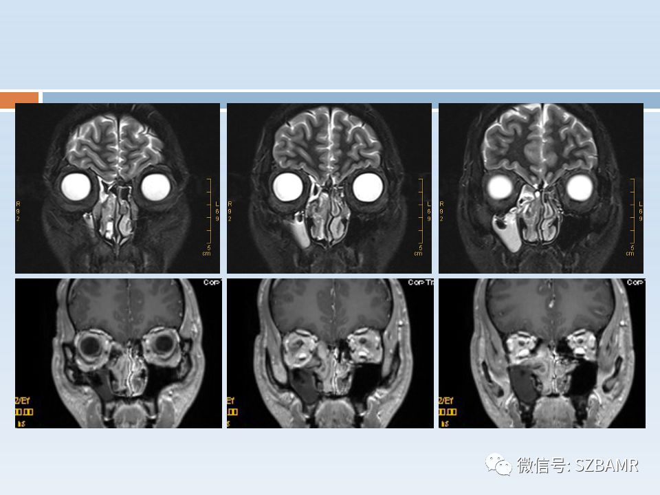 【PPT】鼻腔内翻性乳头状瘤影像学诊断