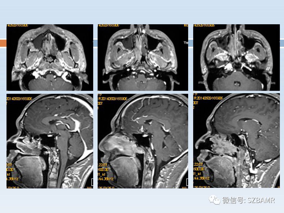 【PPT】鼻腔内翻性乳头状瘤影像学诊断