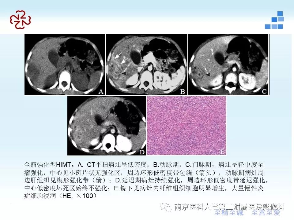 【PPT】肝脏炎性假瘤的影像表现