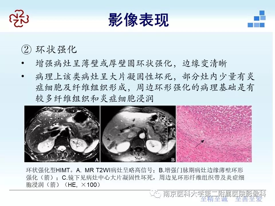 【PPT】肝脏炎性假瘤的影像表现