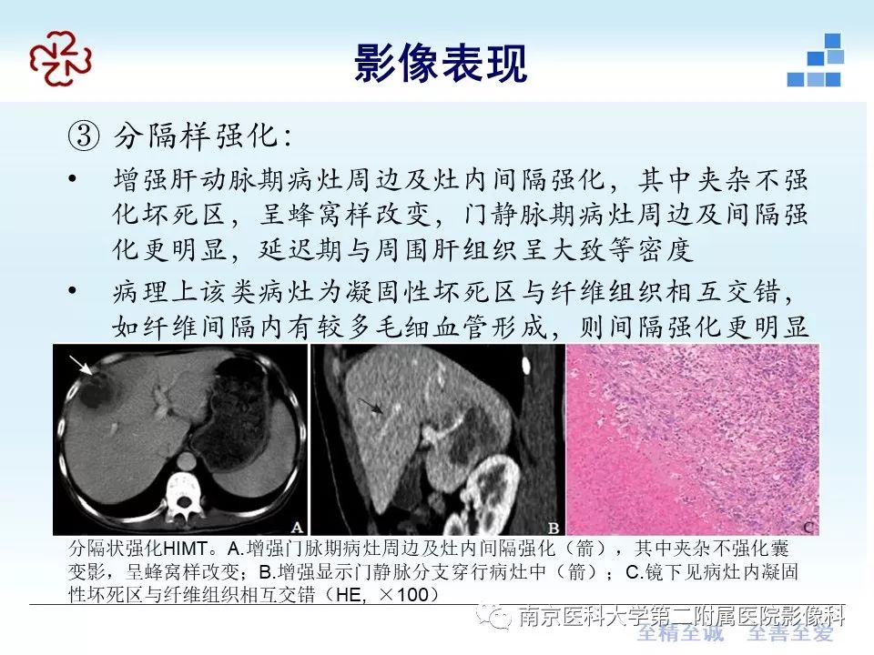 【PPT】肝脏炎性假瘤的影像表现