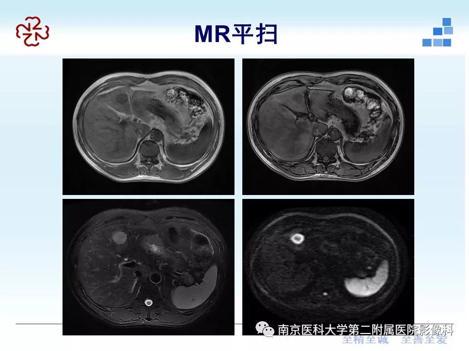 【PPT】肝脏炎性假瘤的影像表现