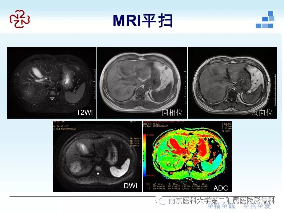 【PPT】肝脏炎性假瘤的影像表现