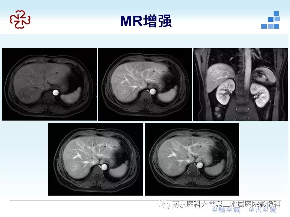 【PPT】肝脏炎性假瘤的影像表现
