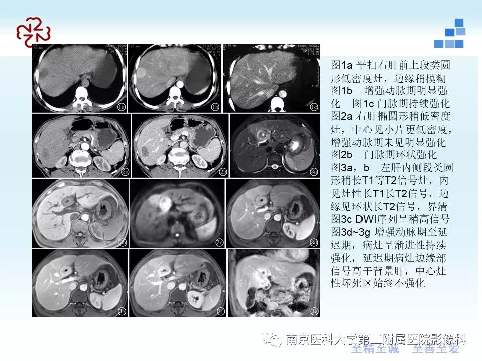 【PPT】肝脏炎性假瘤的影像表现