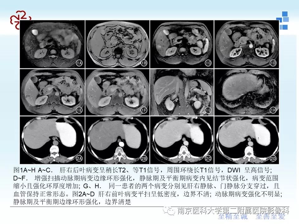 【PPT】肝脏炎性假瘤的影像表现