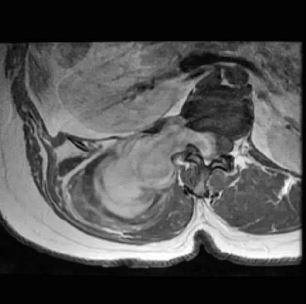 髓外硬膜下肿瘤影像学解析:神经源性肿瘤+脊膜瘤 髓外硬膜下肿瘤影像学解析:神经源性肿瘤+脊膜瘤