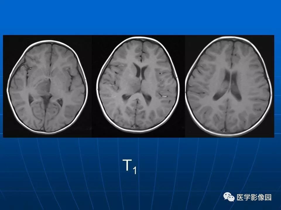 【病例】基底节区脱髓鞘假瘤1例MR 【病例】基底节区脱髓鞘假瘤1例MR