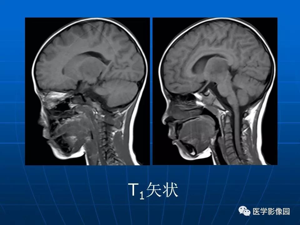 【病例】基底节区脱髓鞘假瘤1例MR 【病例】基底节区脱髓鞘假瘤1例MR