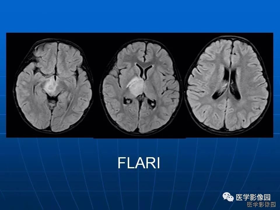 【病例】基底节区脱髓鞘假瘤1例MR 【病例】基底节区脱髓鞘假瘤1例MR