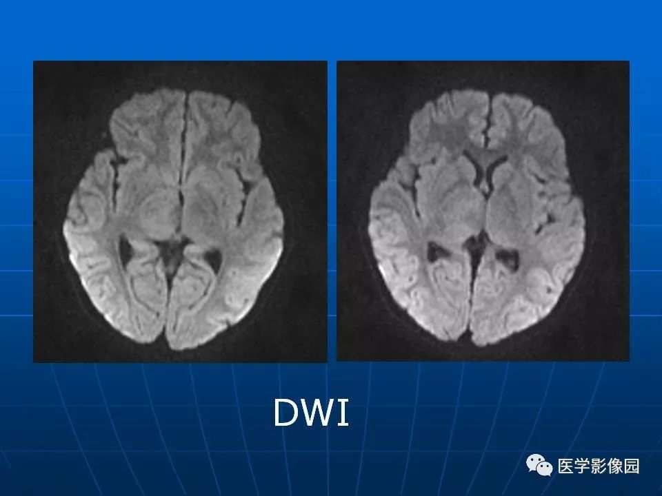 【病例】基底节区脱髓鞘假瘤1例MR 【病例】基底节区脱髓鞘假瘤1例MR