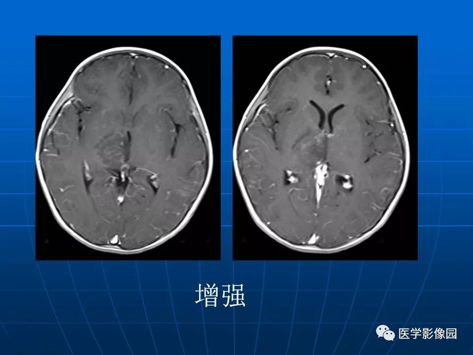 【病例】基底节区脱髓鞘假瘤1例MR 【病例】基底节区脱髓鞘假瘤1例MR