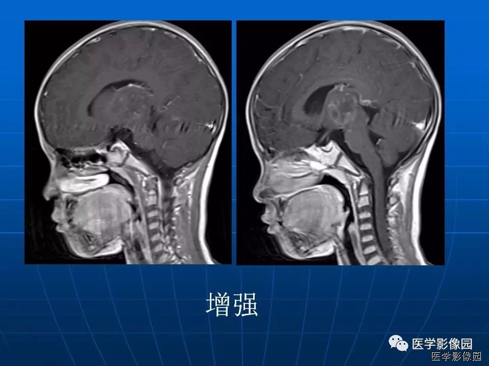 【病例】基底节区脱髓鞘假瘤1例MR 【病例】基底节区脱髓鞘假瘤1例MR