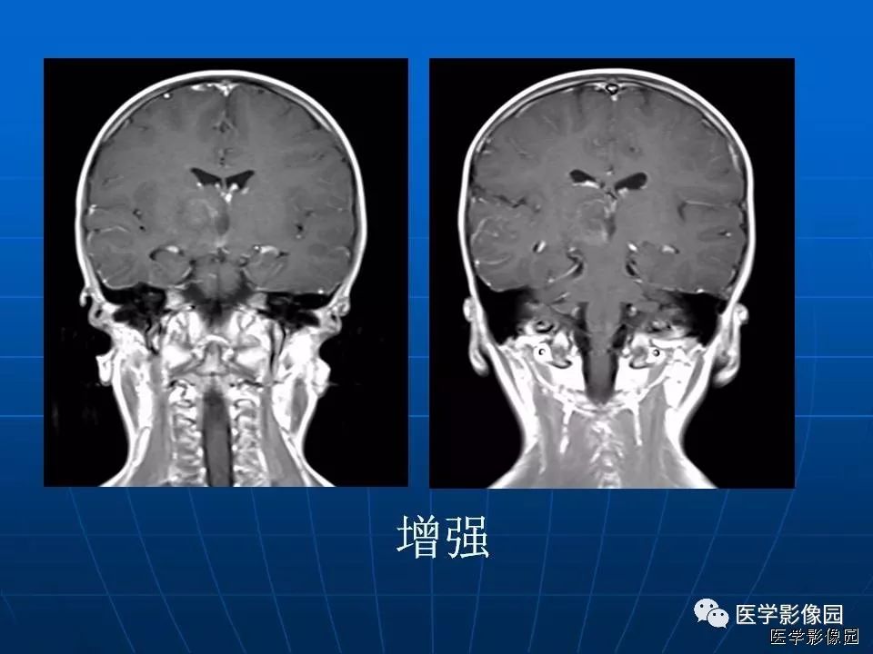【病例】基底节区脱髓鞘假瘤1例MR 【病例】基底节区脱髓鞘假瘤1例MR