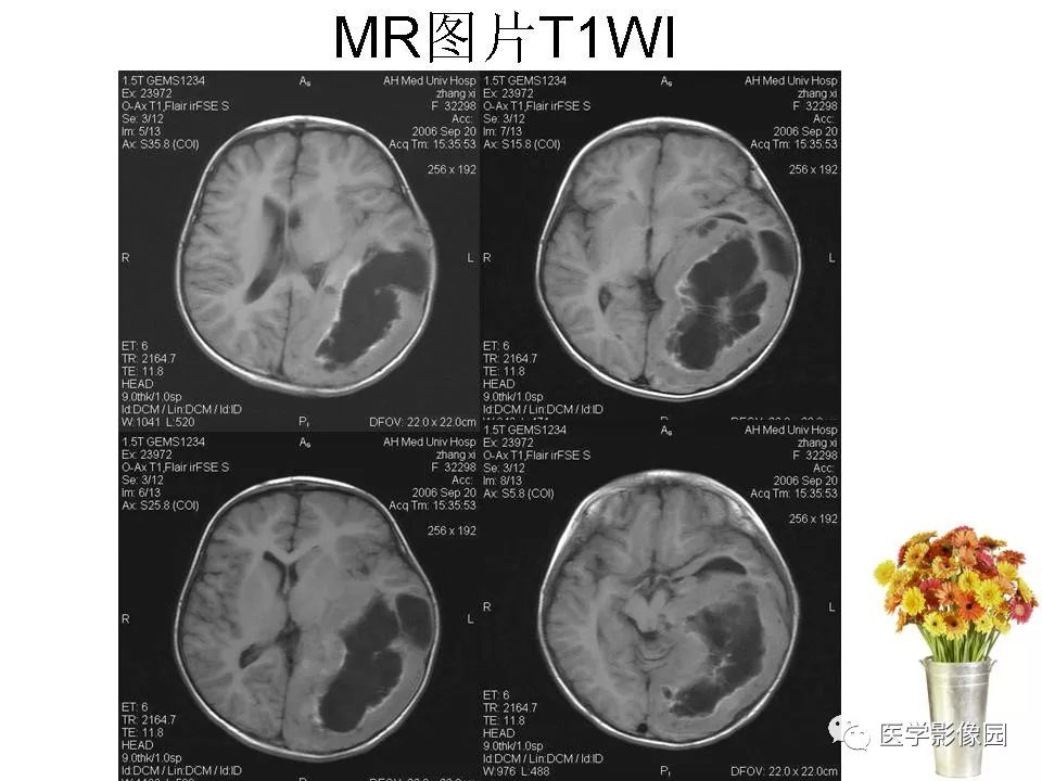 【病例】颅内节细胞胶质瘤1例CT及MR