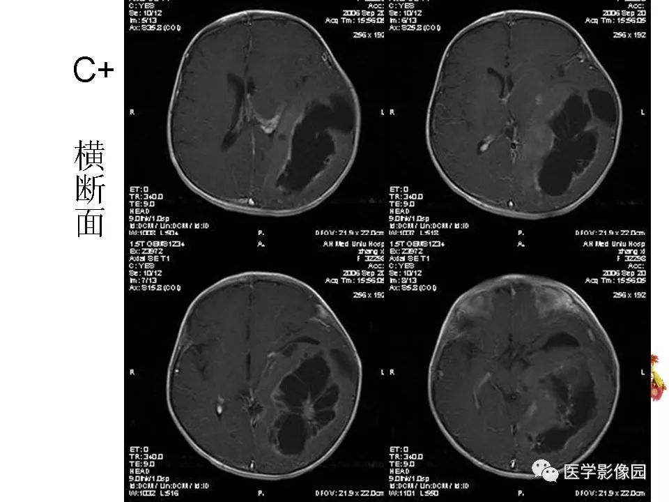 【病例】颅内节细胞胶质瘤1例CT及MR