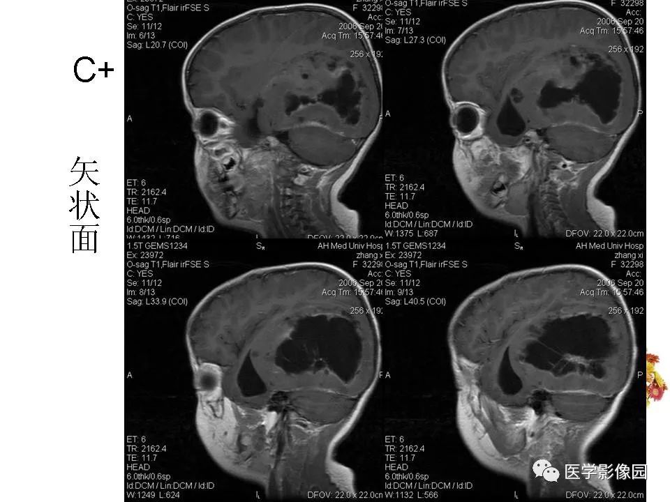 【病例】颅内节细胞胶质瘤1例CT及MR