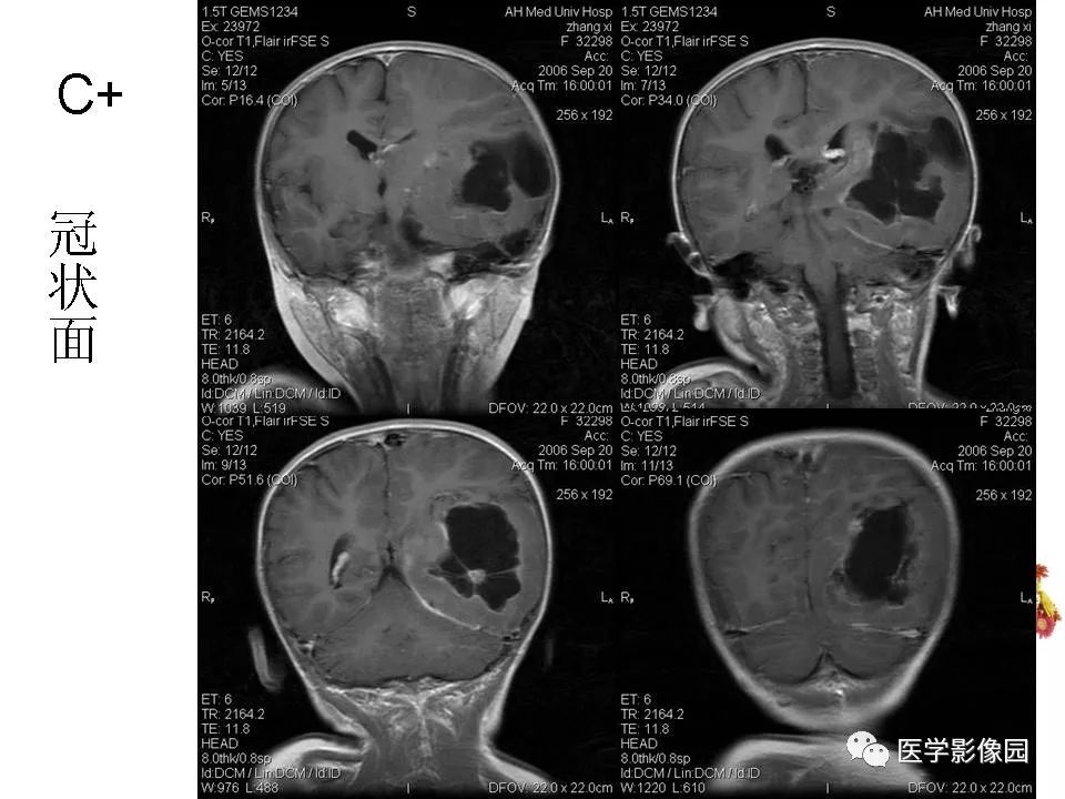 【病例】颅内节细胞胶质瘤1例CT及MR