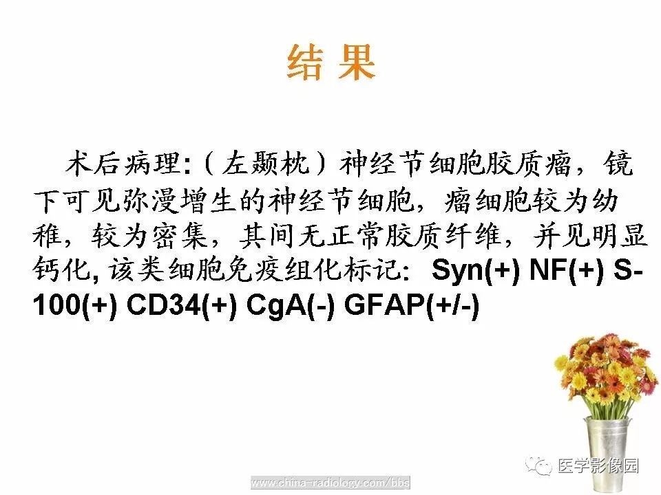 【病例】颅内节细胞胶质瘤1例CT及MR