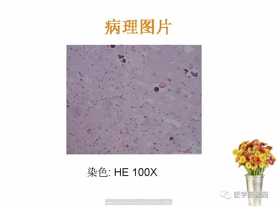 【病例】颅内节细胞胶质瘤1例CT及MR