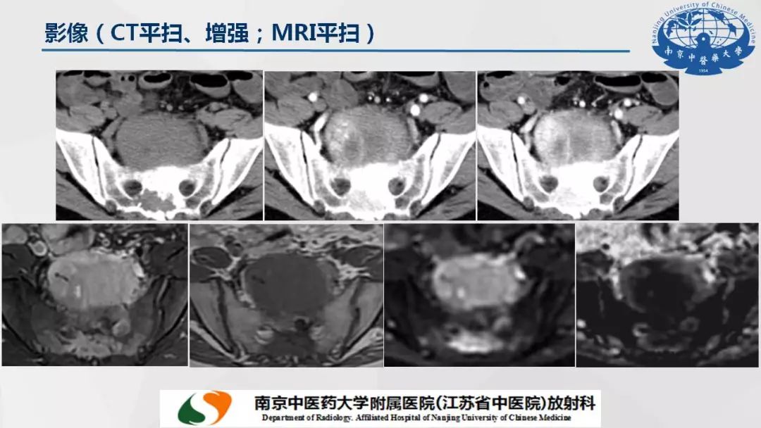 【PPT】孤立性纤维瘤的影像学表现