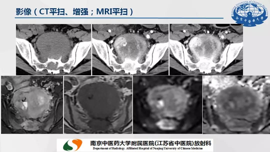 【PPT】孤立性纤维瘤的影像学表现
