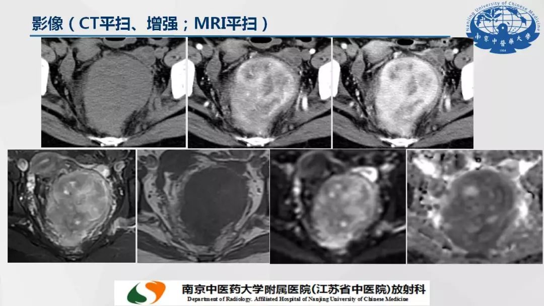 【PPT】孤立性纤维瘤的影像学表现