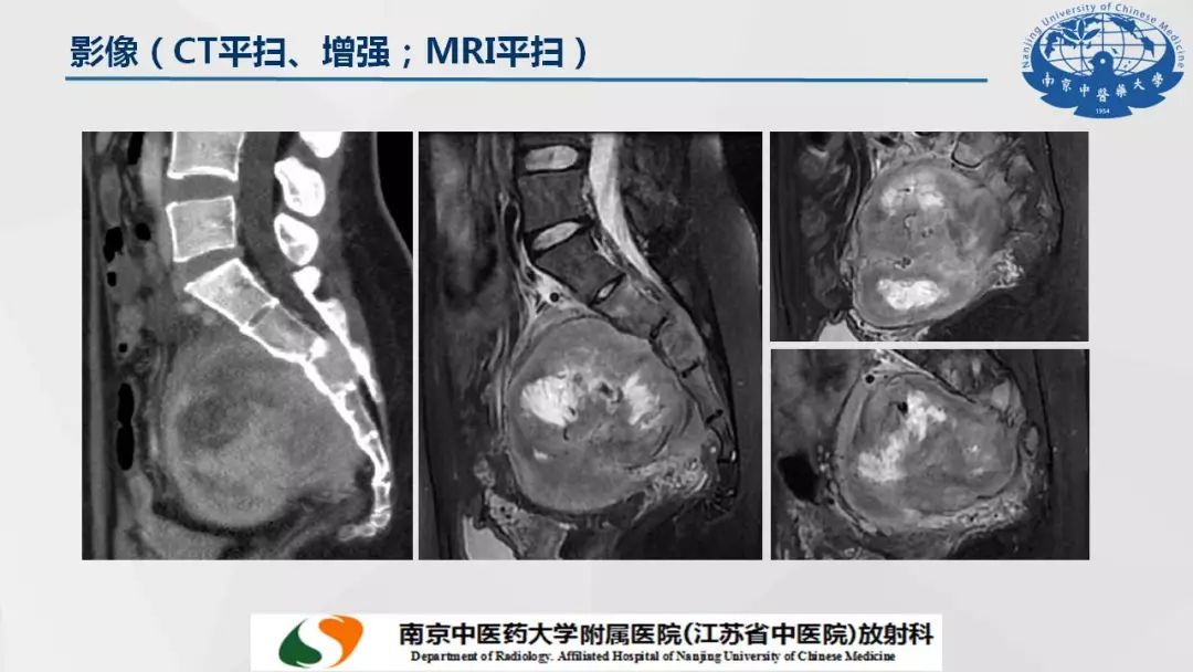 【PPT】孤立性纤维瘤的影像学表现