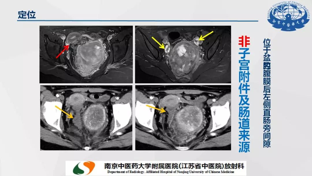 【PPT】孤立性纤维瘤的影像学表现
